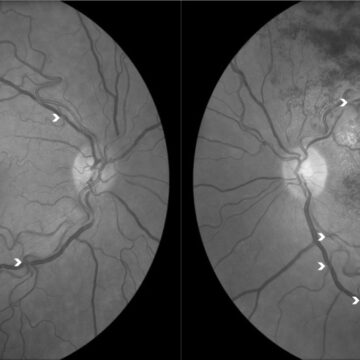 Drammatico studio su Nature: trombosi oculari anche due anni dopo la somministrazione