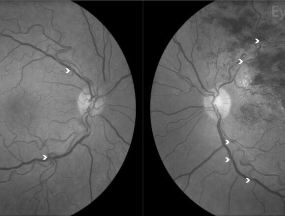 Study image Drammatico studio su Nature: trombosi oculari anche due anni dopo la somministrazione