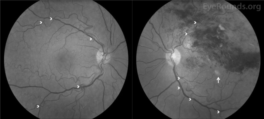 Drammatico studio su Nature: trombosi oculari anche due anni dopo la somministrazione